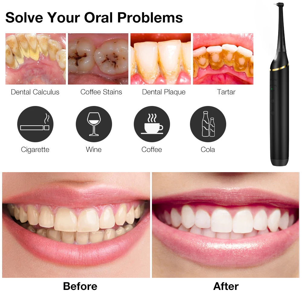 Home Calculus Remover Dental Scaling Electric Scaler Sonic Smoke Stains Tartar Plaque Teeth Whitening Dental Scaler